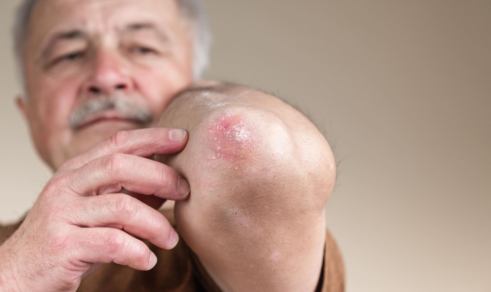 Janeiro Roxo: saiba mais sobre o combate e prevenção à Hanseníase